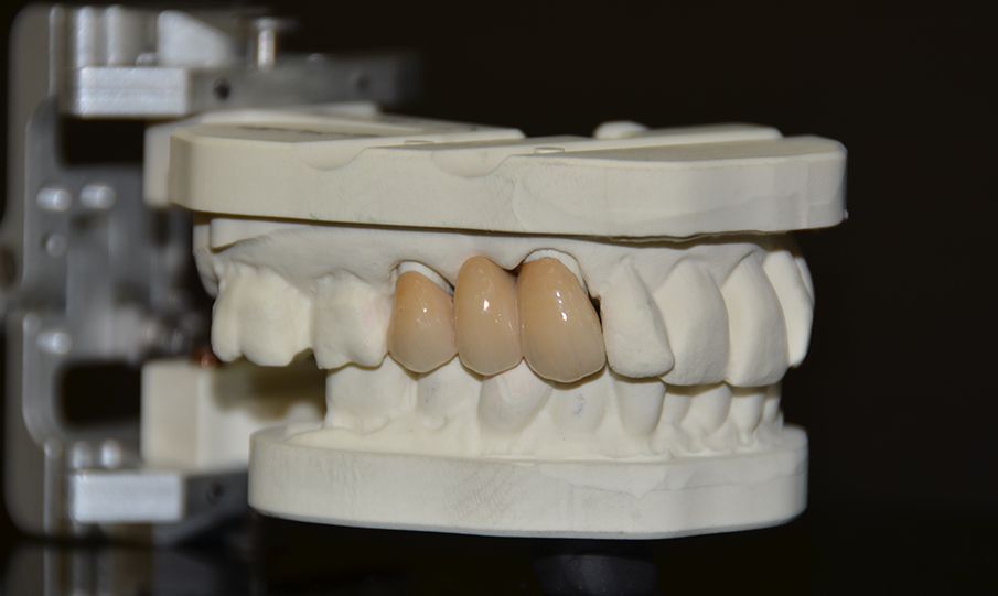 Зубы металлокерамика мосты